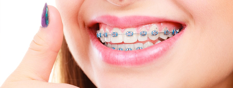 Braces Treatment